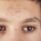 Как избавиться от прыщей? Три способа