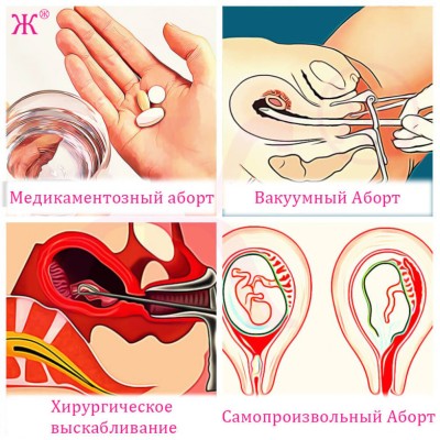 Способы искусственного аборта